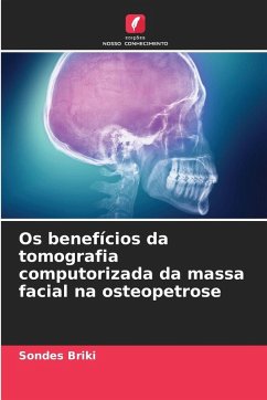 Cover Os benefícios da tomografia computorizada da massa facial na osteopetrose