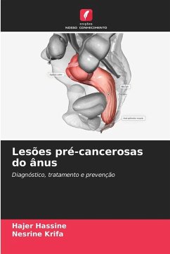 Lesões pré-cancerosas do ânus - Hassine, Hajer;Krifa, Nesrine