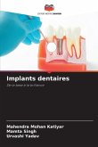 Implants dentaires Implants dentaires