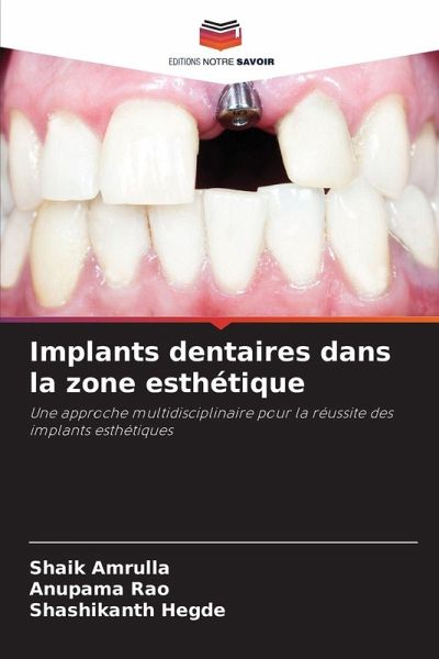 Implants dentaires dans la zone esthétique