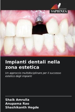 Cover Impianti dentali nella zona estetica