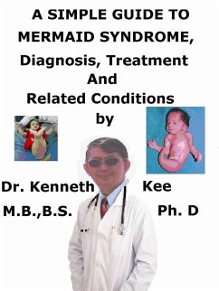 A Simple Guide to Mermaid Syndrome, Diagnosis, Treatment and Related Conditions (eBook, ePUB) - Kee, Kenneth