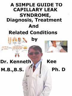 A Simple Guide to Capillary Leak Syndrome, Diagnosis, Treatment and Related Conditions (eBook, ePUB) - Kee, Kenneth