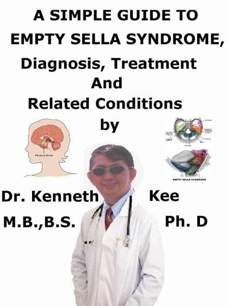 A Simple Guide to Empty Sella Syndrome, Diagnosis, Treatment and Related Conditions (eBook, ePUB) A Simple Guide to Empty Sella Syndrome, Diagnosis, Treatment and Related Conditions (eBook, ePUB)