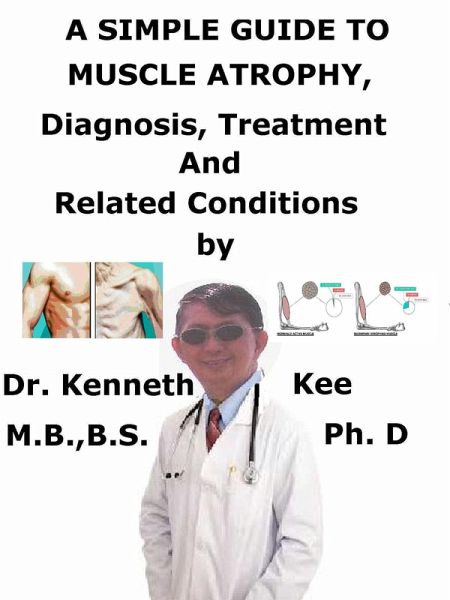 A Simple Guide to Muscle Atrophy, Diagnosis, Treatment and Related Conditions (eBook, ePUB)