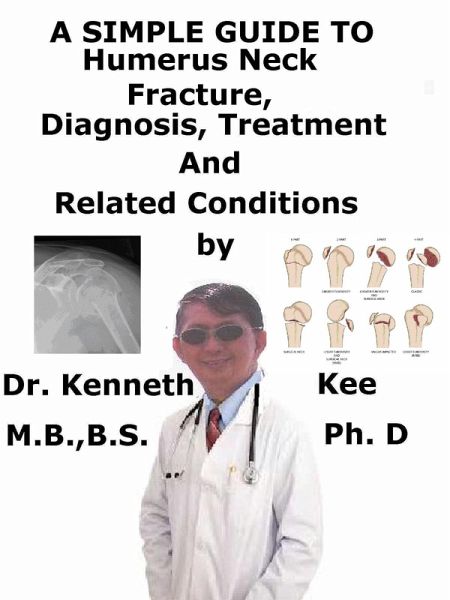 A Simple Guide to Humerus Neck Fracture, (As narrated by A Patient), Diagnosis, Treatment and Related Conditions (eBook, ePUB)