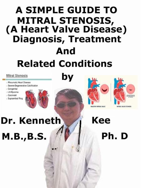 A Simple Guide to Mitral Stenosis (A Heart Valve Disease), Diagnosis, Treatment and Related Conditions (eBook, ePUB)