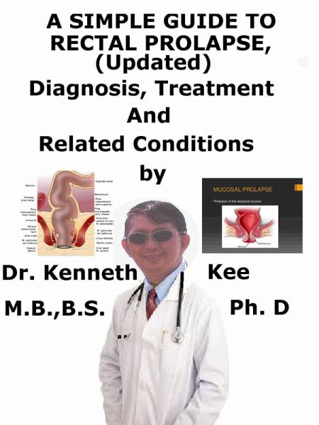 A Simple Guide to Rectal Prolapse, (Updated) diagnosis, Treatment and Related Conditions (eBook, ePUB)
