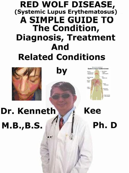 Red Wolf Disease (Systemic Lupus Erythematosus), A Simple Guide To The Condition, Diagnosis, Treatment And Related Conditions (eBook, ePUB) Red Wolf Disease (Systemic Lupus Erythematosus), A Simple Guide To The Condition, Diagnosis, Treatment And Related Conditions (eBook, ePUB)