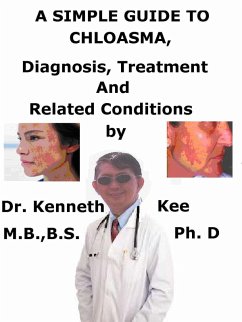 A Simple Guide to Chloasma, Diagnosis, Treatment and Related Conditions (eBook, ePUB) - Kee, Kenneth