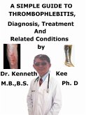 A Simple Guide to Thrombophlebitis, Diagnosis, Treatment and Related Conditions (eBook, ePUB)