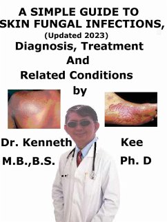 Cover A Simple Guide to Skin Fungal Infections, (Updated 2023) Diagnosis, Treatment and Related Conditions (eBook, ePUB)
