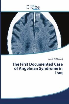 The First Documented Case of Angelman Syndrome in Iraq