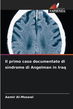 Cover Il primo caso documentato di sindrome di Angelman in Iraq