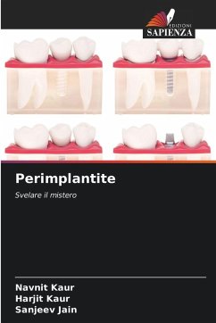 Perimplantite - Kaur, Navnit;Kaur, Harjit;Jain, Sanjeev