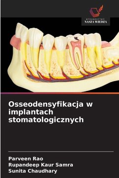 Cover Osseodensyfikacja w implantach stomatologicznych