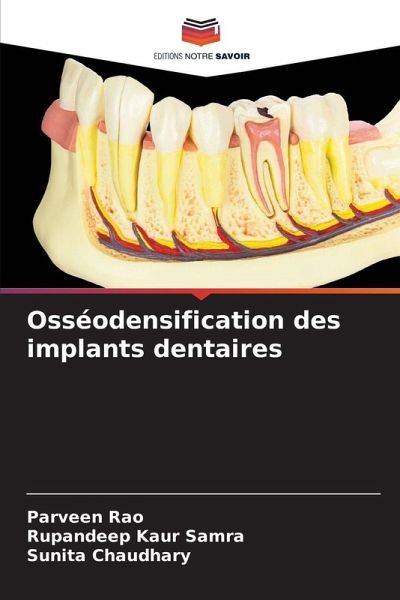 Osséodensification des implants dentaires