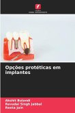 Opções protéticas em implantes